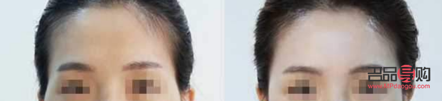 眼睛凹陷脂肪填充需要多少錢(填充太陽(yáng)凹用什么材料最好)