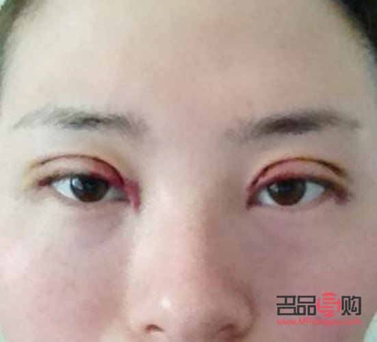雙眼皮手術(shù)失敗案例揭秘：八種典型圖片引關(guān)注