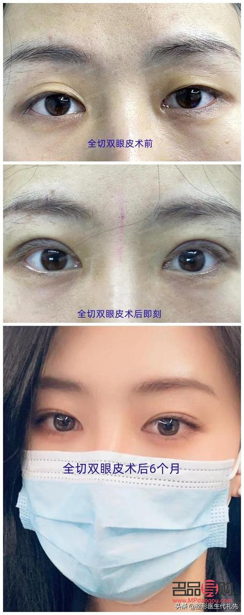 做雙眼皮哪種效果最好(做雙眼皮哪種效果最好最安全)