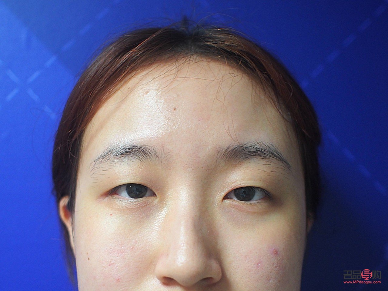 輕度上眼皮外翻圖片(輕度上眼皮外翻圖片女)