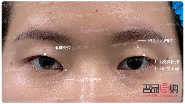 輕度上眼皮外翻圖片(輕度上眼皮外翻圖片女)