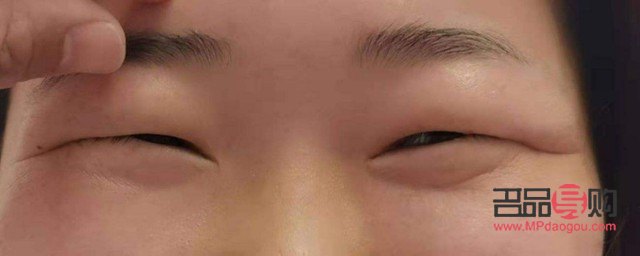 <h3>消除天生腫眼泡的有效方法</h3>