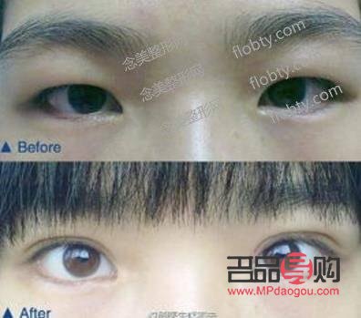 <h3>消除天生腫眼泡的有效方法</h3>