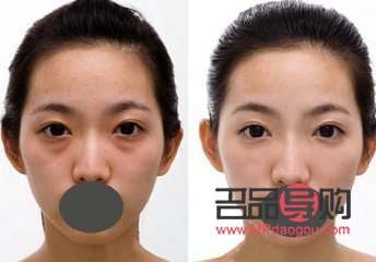 消除天生腫眼泡的有效方法