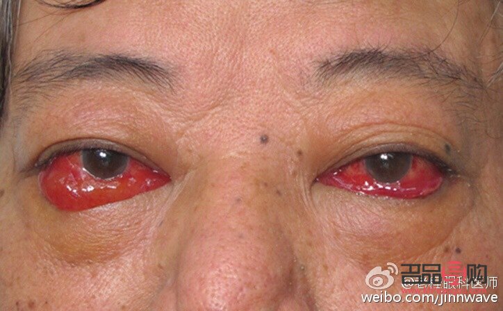 甲亢眼突自行恢復(fù)的小竅門知乎(甲亢眼突能自愈嗎)