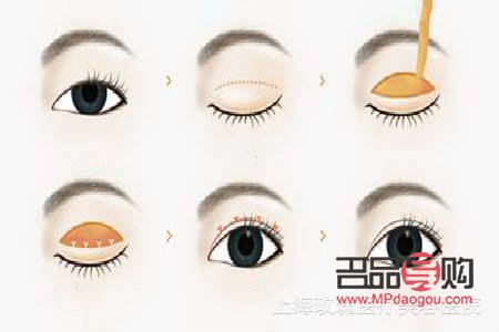 做雙眼皮手術(shù)大概需要多久(做雙眼皮手術(shù)大概需要多久時間)