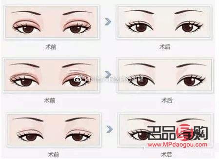 做雙眼皮手術(shù)大概需要多久(做雙眼皮手術(shù)大概需要多久時間)