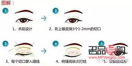 做雙眼皮手術(shù)大概需要多久(做雙眼皮手術(shù)大概需要多久時間)