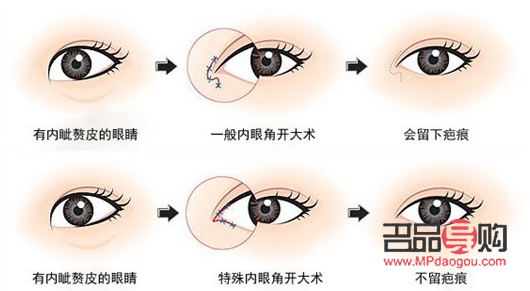開眼角手術(shù)要多少錢(開眼角手術(shù)要多少錢?)