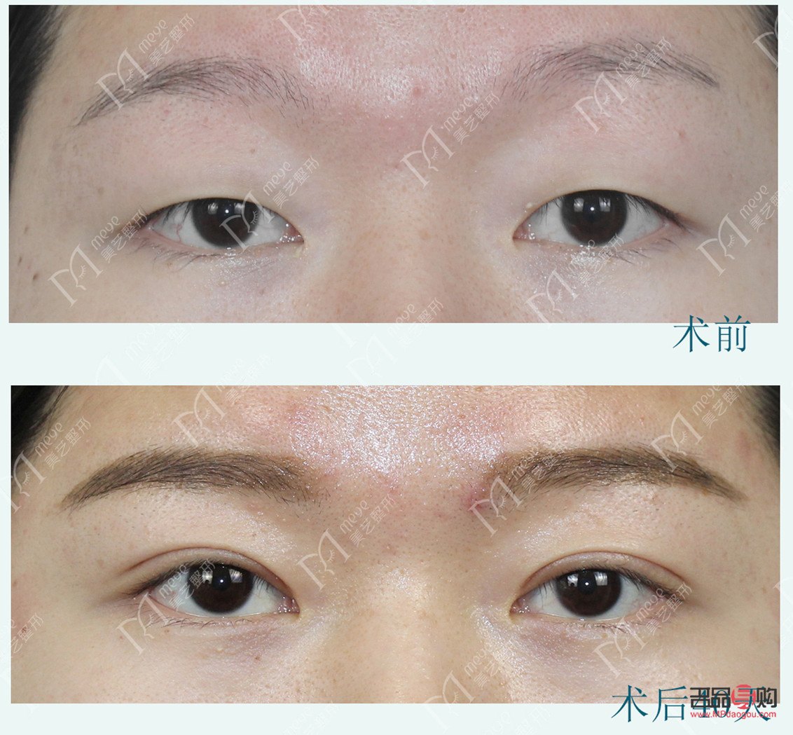 <h3>提肌無力雙眼皮手術費用及注意事項</h3>