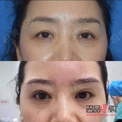 <h3>雙眼皮上眼皮松弛下垂怎么辦？專業(yè)解決方案與日常護(hù)理指南</h3>