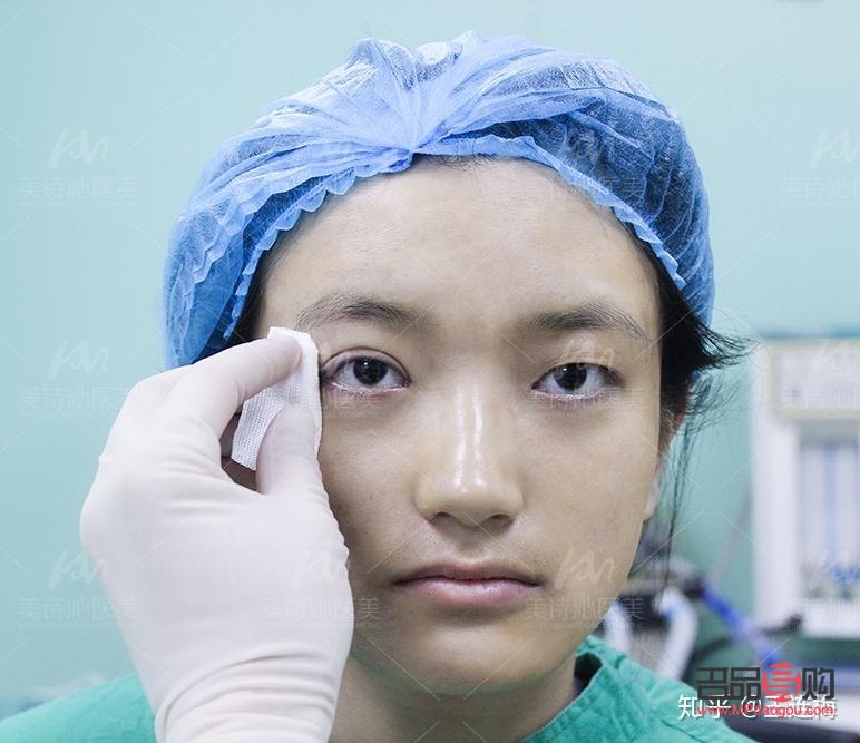 天生腫眼泡不手術(shù)，如何有效改善？