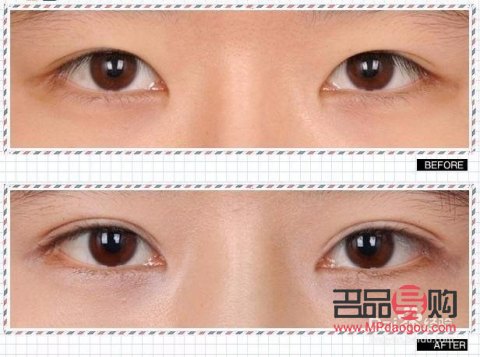 銀川雙眼皮手術(shù)哪家好(銀川雙眼皮手術(shù)哪家好)