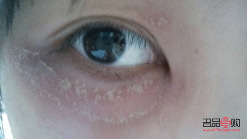 眼周癢(眼周癢是怎么回事)