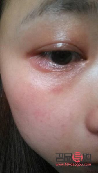 眼周癢(眼周癢是怎么回事)