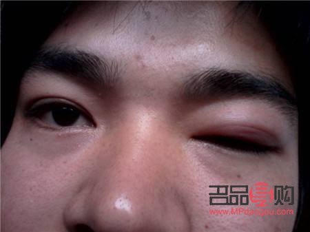 眼睛下眼皮腫了如何快速消除(眼睛下眼皮腫了如何快速消除小妙招)