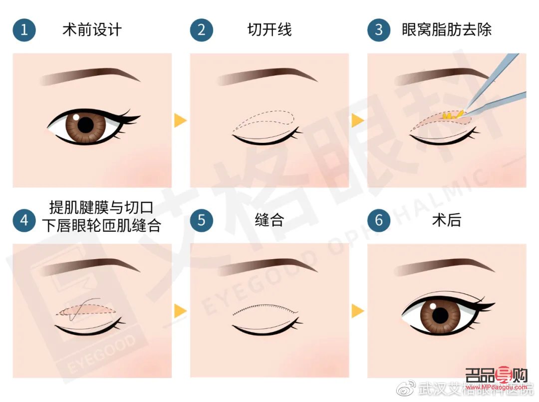 <h3>開眼角割雙眼皮手術(shù)時間詳解</h3>