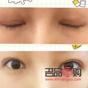 <h3>開眼角割雙眼皮手術(shù)時間詳解</h3>