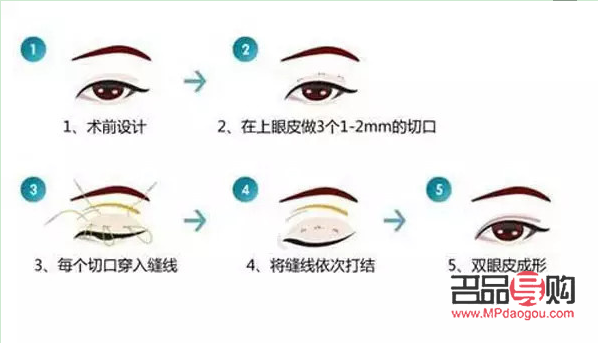 <h3>開眼角割雙眼皮手術(shù)時間詳解</h3>