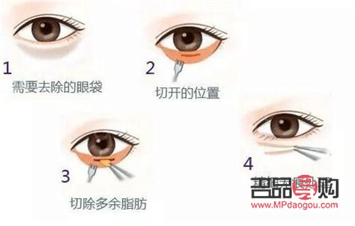 <h3>割眼袋好嗎？了解眼袋手術(shù)及其利弊</h3>