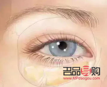 割眼袋好嗎？了解眼袋手術(shù)及其利弊