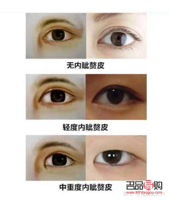內(nèi)眼角開大了有什么影響嗎(內(nèi)眼角開大了有什么影響嗎)