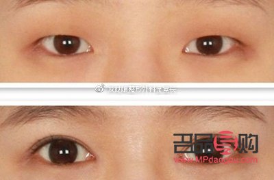 雙眼皮眼角疤痕增生多久消失(雙眼皮眼角疤痕增生多久消失正常)