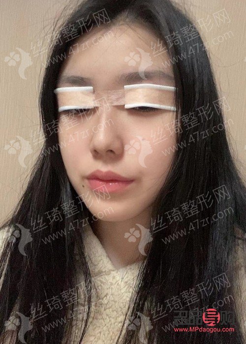 <h3>眼睛一高一低矯正手術(shù)費(fèi)用及注意事項(xiàng)</h3>