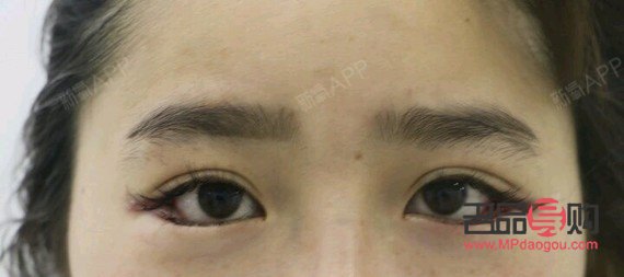 <h3>眼睛一高一低矯正手術(shù)費(fèi)用及注意事項(xiàng)</h3>