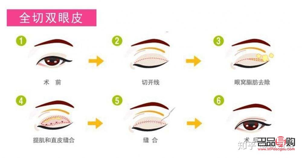 埋眼線與割雙眼皮：哪個更適合你？