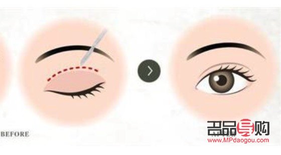 <h3>納米雙眼皮與埋線的區(qū)別詳解</h3>
