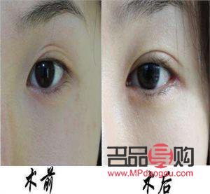 納米雙眼皮與埋線的區(qū)別詳解
