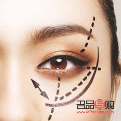 雙眼皮埋線圖片 恢復(雙眼皮埋線圖片 恢復過程)