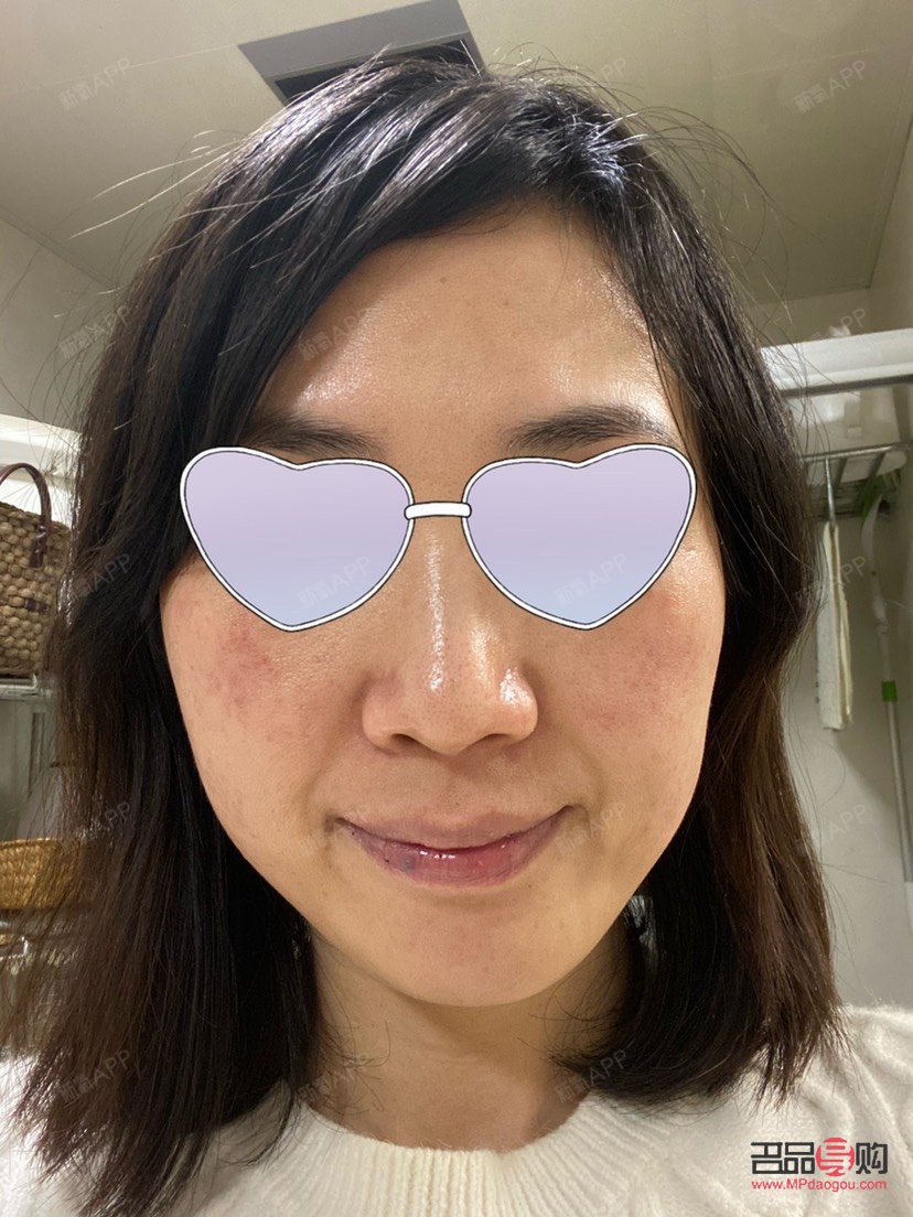 眼部熱拉提做后會腫嗎(眼部熱拉提做后會腫嗎)