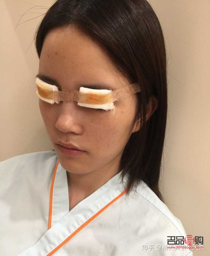 <h3>雙眼皮做寬了能否修復(fù)？</h3>