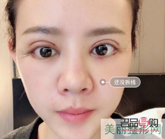 <h3>雙眼皮做寬了能否修復(fù)？</h3>