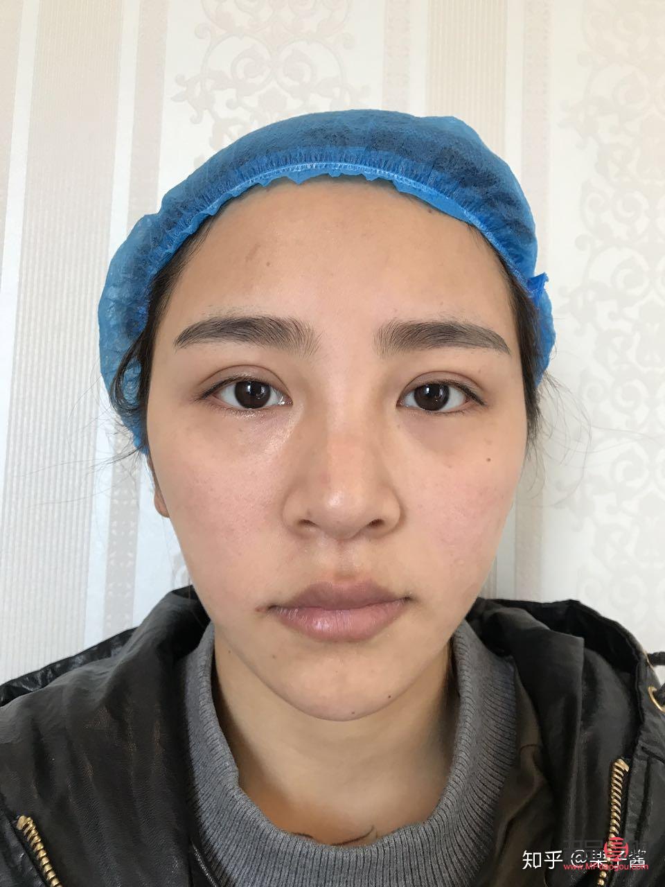 <h3>雙眼皮做寬了能否修復(fù)？</h3>