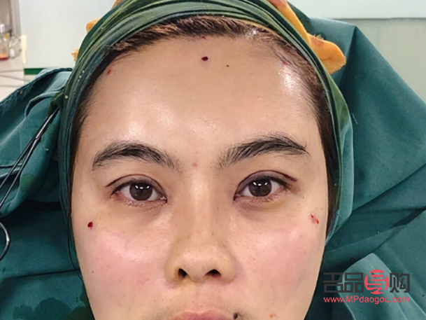 微整眼部(微整眼部提拉后的感覺)