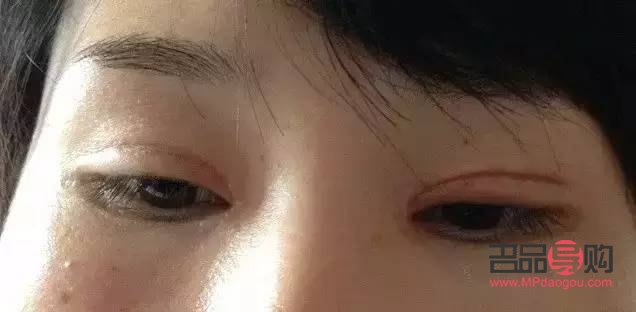 假性雙眼皮怎么變成雙眼皮(假性雙眼皮怎么變成雙眼皮了)