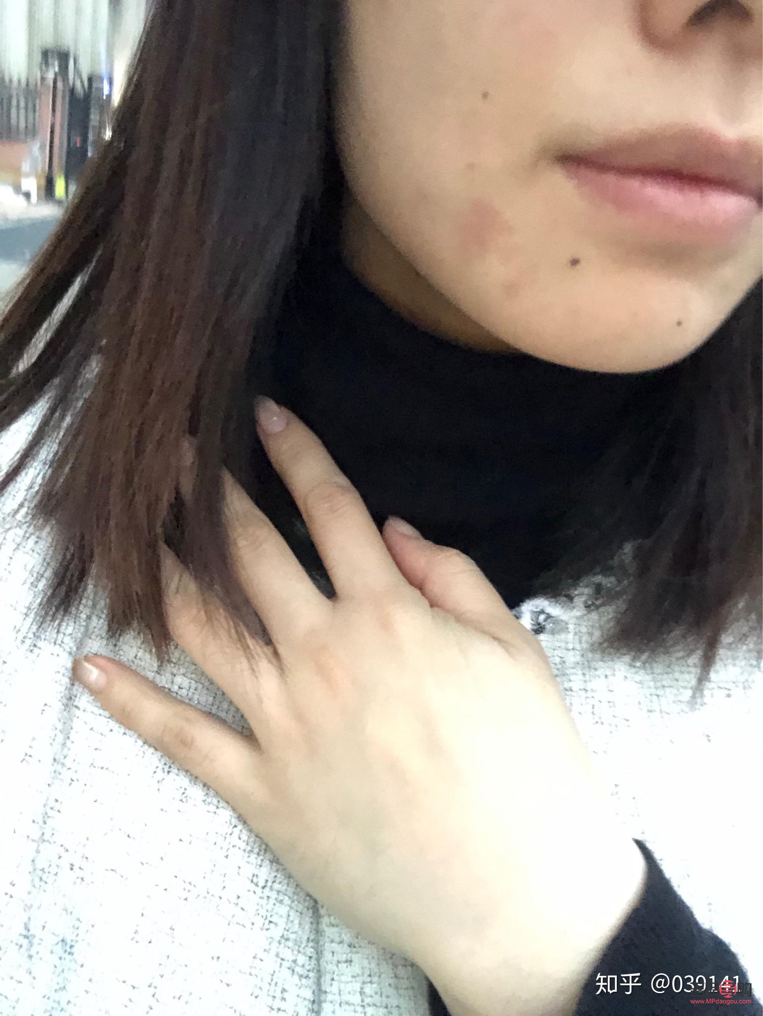 眼角回包手術(shù)過(guò)程多久(眼角回包手術(shù)過(guò)程多久恢復(fù))