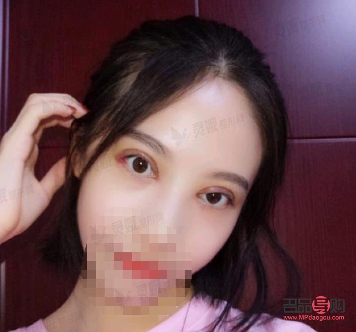 7.5毫米雙眼皮恢復(fù)圖片(7.5毫米雙眼皮恢復(fù)圖片大全)