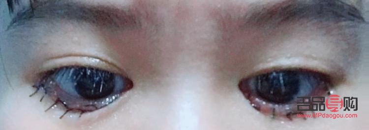 眼睛倒睫手術(shù)后會留疤嗎(眼睛倒睫手術(shù)后會留疤嗎圖片)