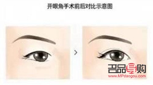 開眼角與不開眼角的區(qū)別(開眼角與不開眼角的區(qū)別圖)
