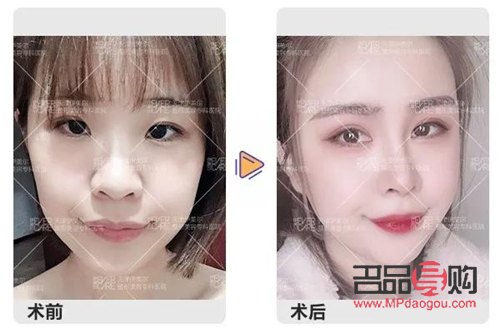 翹睫雙眼皮是永久的嗎怎么做(翹睫雙眼皮是永久的嗎怎么做手術(shù))