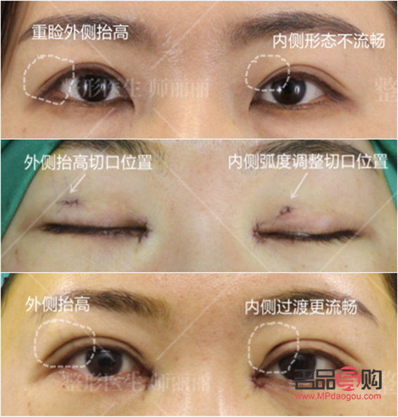 做什么雙眼皮恢復(fù)快(做什么雙眼皮恢復(fù)快能保持永久)