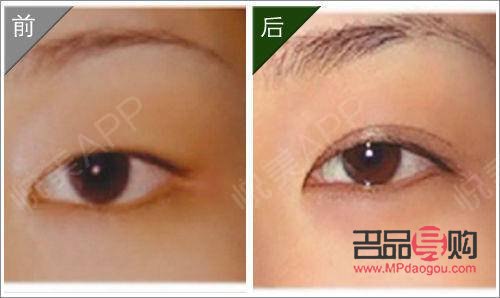 <h3>內(nèi)雙如何埋線(xiàn)打造雙眼皮魅力</h3>