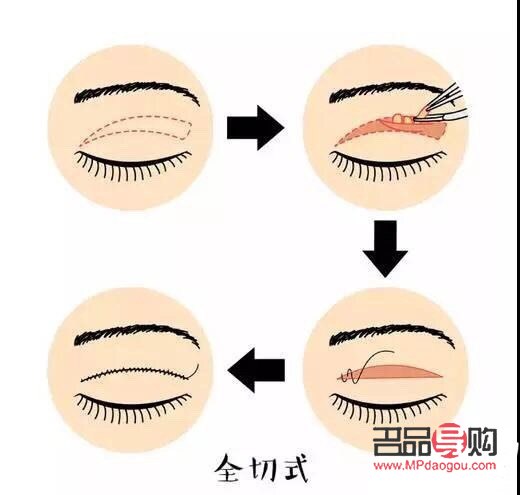 <h3>內(nèi)雙如何埋線(xiàn)打造雙眼皮魅力</h3>