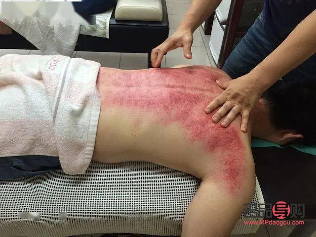 刮痧后的身體護理之道