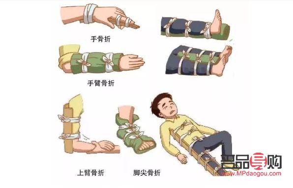 骨折后如何科學護理身體