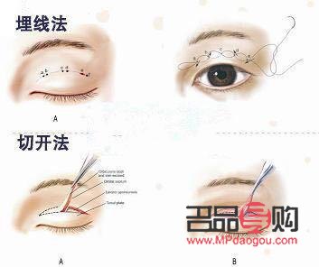 割雙眼皮手術(shù)前需要注意什么(割雙眼皮手術(shù)前需要注意什么事項(xiàng))